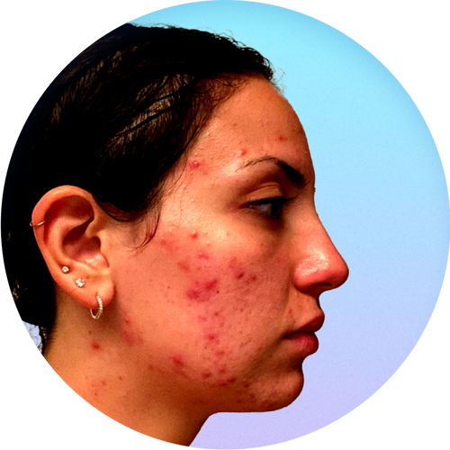 A profile view of a young woman’s face who has acne which represents skin before using Liquid Oxygen