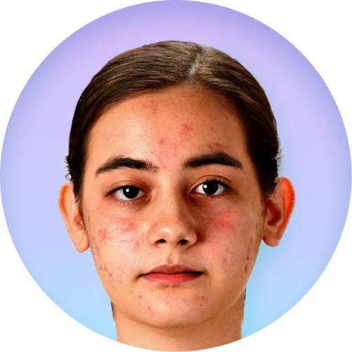 A profile view of a young woman’s face who has acne which represents skin before using Liquid Oxygen