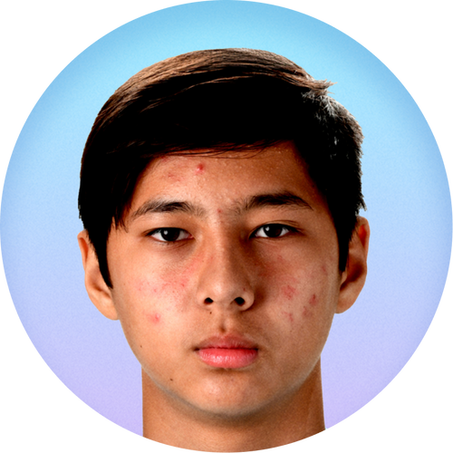 A profile view of a young man’s face who has acne which represents skin before using Liquid Oxygen