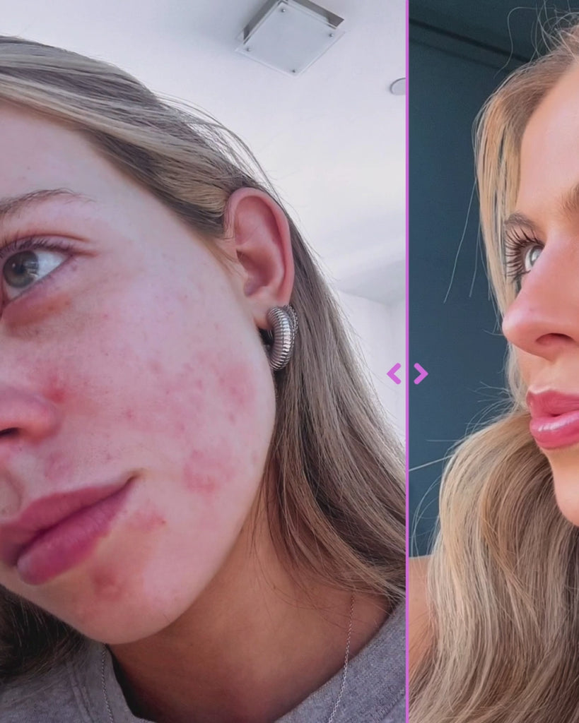 3-Step Acne Treatment System